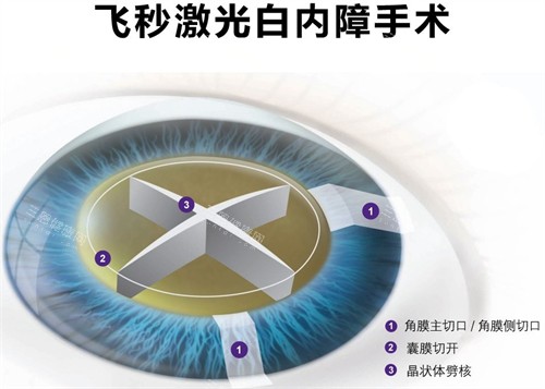 普瑞眼科医院做白内障手术怎么样？普瑞在白内障领域掌握多种新型技术！