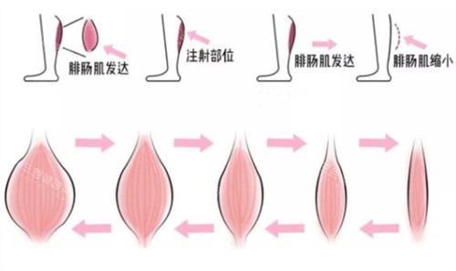 瘦腿注射前后对比
