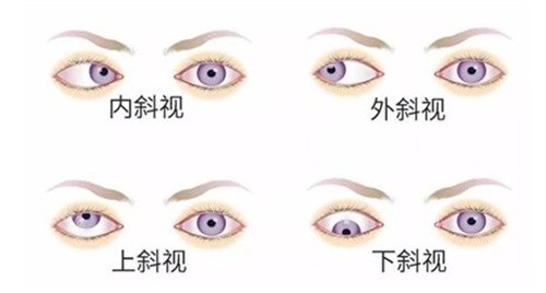斜视手术费用大约多少钱？3000-20000元不等，病情、术式、医院等级差异大