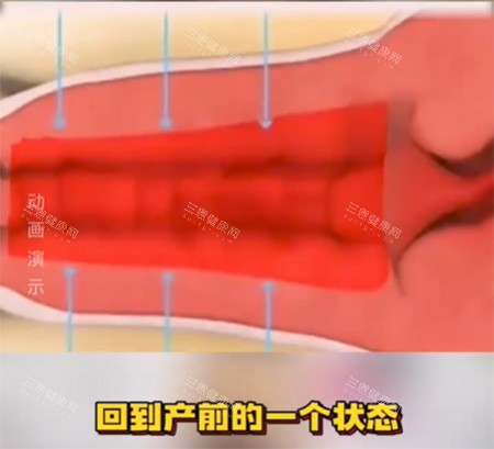 私密紧缩针能保持多少年紧致?打紧缩针能管6~12个月,维持半年到一年不等因人而异