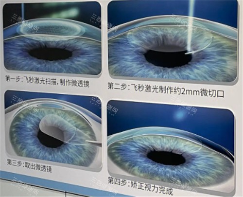 飞秒手术过程图