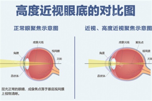 芜湖做近视眼手术收费价格表！是2025年更新后的价格明细表！