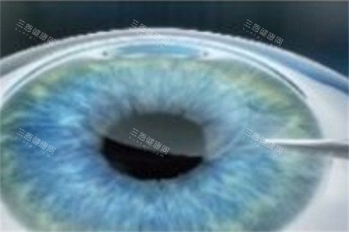 全飞秒分离基质层 全飞秒分离基质层