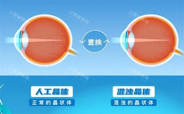 人工晶体置换示意图