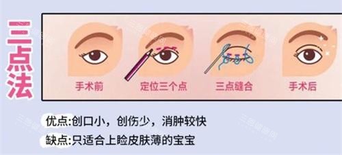 双眼皮手术三点法动画演示图