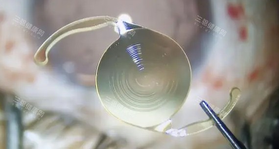 白内障手术收费标准2025揭晓，白内障囊外摘除术2000元起、超声乳化5000元起、飞秒激光15000元起~