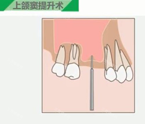 承德名士口腔医院看牙消费高不高？不算高，2025名士口腔种植牙2580起/矫正6980起/美白570起