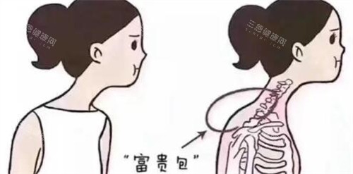 青岛哪家医院做富贵包手术靠谱点？华韩整形术前3D模拟+术后抗复发管理，超安心！