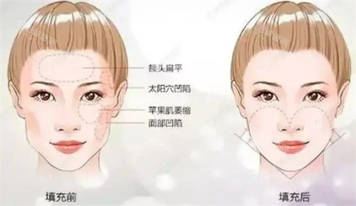 上海填充面颊怎么收费的？玻尿酸2000+自体脂肪8000+胶原蛋白5000+