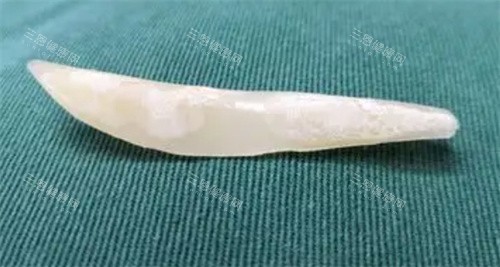 隆鼻假体图片
