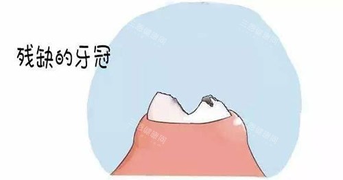 南京茀莱堡口腔看牙技术好吗？显微镜下操作+热牙胶填充，疼了3年的牙终于得救！