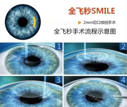 2025更新！山东滕州启明眼科近视手术价格表大公开：全飞秒、半飞秒等各术式费用明细，收费标准全解析
