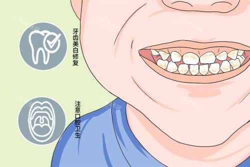 四环素牙牙贴面实例分享：灰黄牙遮丑理想方案，拍照终于敢露齿笑了！