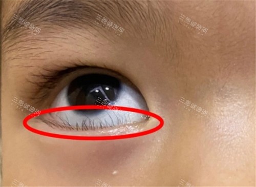 睑内翻倒睫照片