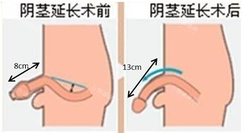 阴茎增长手术前后对比动画图