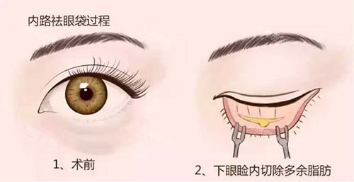 成都达芬奇去眼袋多少钱？合理收费还你明亮双眸，开启眼部年轻化！