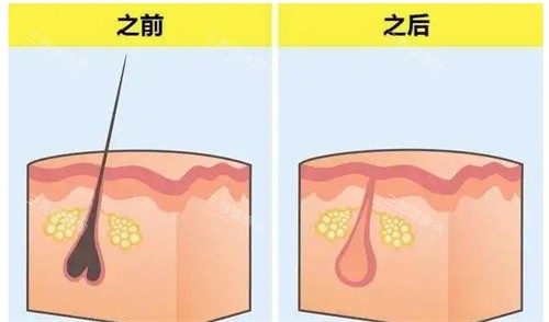 上海江城皮肤医院冰点脱毛怎么样？成效/价格/术后护理一篇说清，深扒冰点脱毛的真实优缺点！