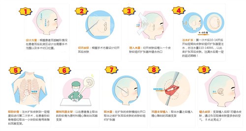广州高尚耳再造怎么样？从3D打印支架到成活率98%，口碑优势全靠这3点