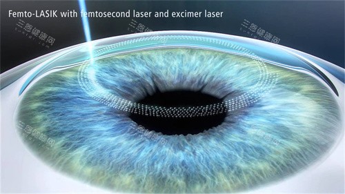 西京医院近视眼手术哪位医生做得好?赵炜、孙丽娟、师蓉做近视眼手术好