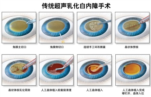 南昌市白内障手术政策：65岁户籍老人可享免费治疗，附低收入证明办理全流程指南