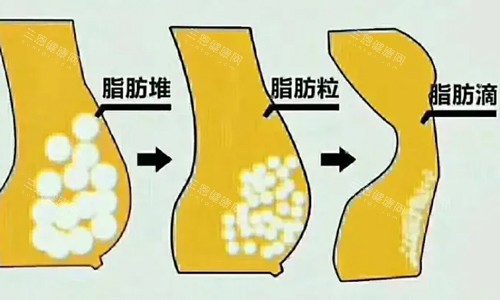 脂肪型胸部脂肪展示