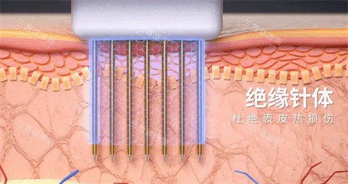 黄金微针针头图解