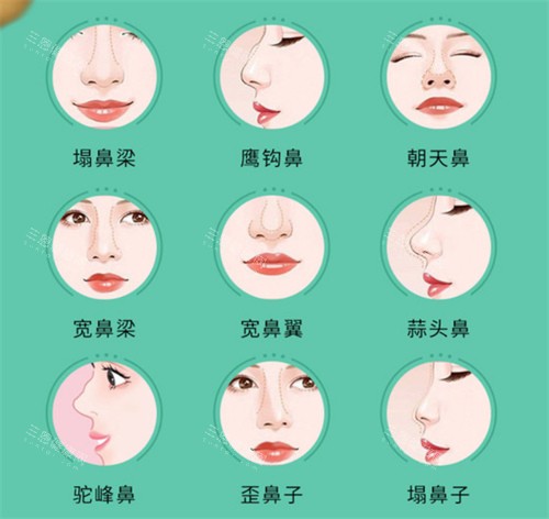 房志强医生做鼻子价位在多少？硅胶隆鼻10000元起/耳软骨隆鼻18000元起/鼻综合2万元起~