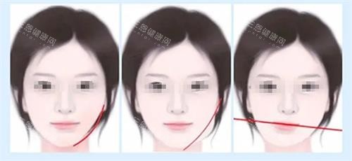脸型不对称矫正多少钱？自体脂肪填充5800元起、颧骨内推26000元起