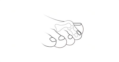 二脚趾过长透视图