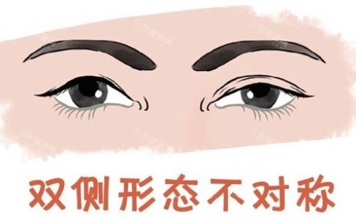杜园园双眼皮修复价格来分享，双眼皮修复价格在4万-8万元起！不同修复难度价格不等~