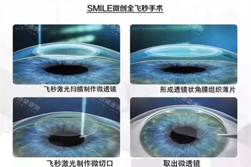 兰州做近视手术贵不贵？1200度选半飞秒8800元起，1800度选ICL晶体植入28000元起全揭秘