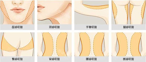 福州靓壹生吸脂怎么样?吸脂做得好,术后免拆线,皮肤没有凹凸不平很平整