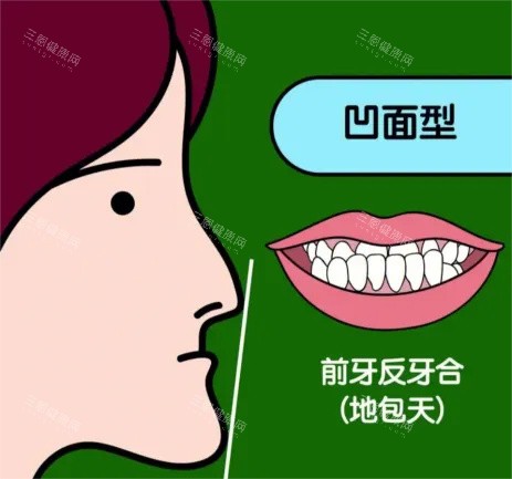 地包天手术后悔实录！亲身经历分享手术前后细节，避坑指南帮你少走弯路！