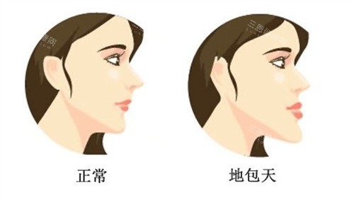 地包天