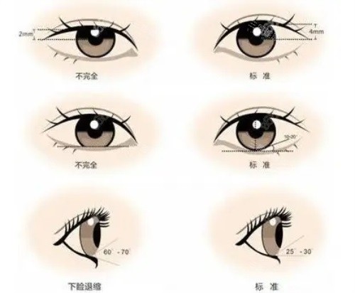 海峡医疗美容医院割双眼皮成效好吗？价格贵不贵？真实评价来了