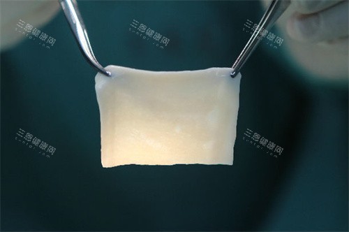 男性生物补片手术费用透明表:增粗手术2万元起步!生物补片增粗手术价格表公布