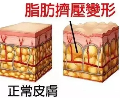 长沙中科皮肤病医院祛疤结果实测！激光VS手术哪个更干净？