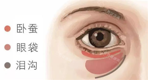 广州陈雪涛医生眼袋脂肪重置手术费用多少钱？微痕内切5980+复合型眼袋修复9800+急速改善12800+