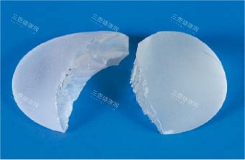 成都隆胸假体取出费用多少才合理?6000元到2万起差异解析!
