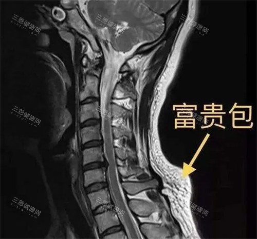 CT下的富贵包图示