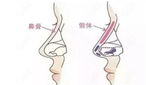 李劲良隆鼻风格怎么样？自然派技术流医生的真实口碑揭秘，李劲良做鼻子技术全解析~