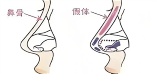 大连何栋良鼻综合价格全解析，鼻综合6万元起~鼻整形不同手术价格一览~