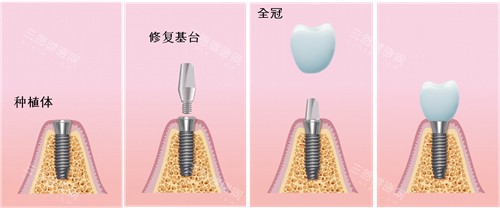 自贡市牙科医院收费标准2025版，内含种植牙|牙齿矫正|儿牙|镶牙修复|贴面美白等！