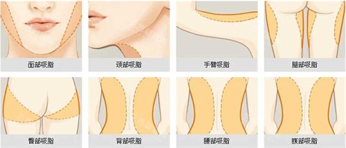 重庆军美吸脂真人实录：腰腹/大腿环吸价格、术后穿塑身衣注意事项全攻略！