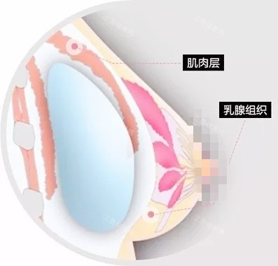 双平面丰胸
