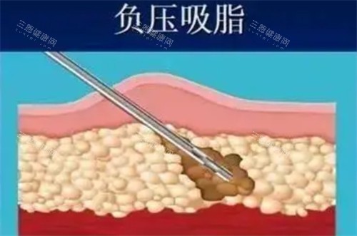 重庆铜雀台整形医院吸脂技术怎么样？田鹏飞医生打针反馈如何？特色项目盘点！