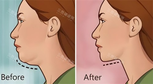 热拉提前后对比 热拉提前后对比