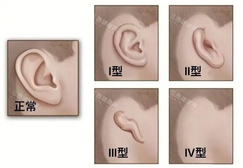 耳畸形的种类 耳畸形的种类
