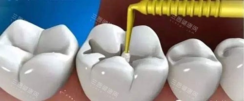 中诺口腔2025年价目表更新！种植牙/矫正/补牙/根管治疗价格，看牙不踩坑！