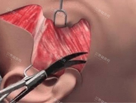 拉皮手术动画图